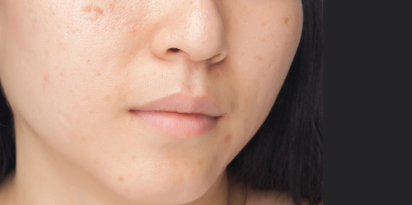 Identificar y tratar las manchas en la piel