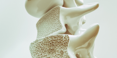 Osteoporosis, la enfermedad silenciosa