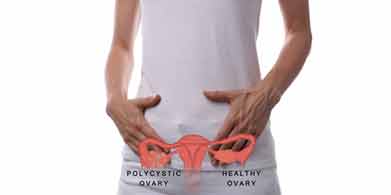 Síndrome de ovario poliquístico (SOP): tratamiento completo