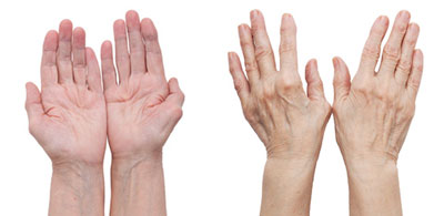 La artrosis: Causas y síntomas de este trastorno articular