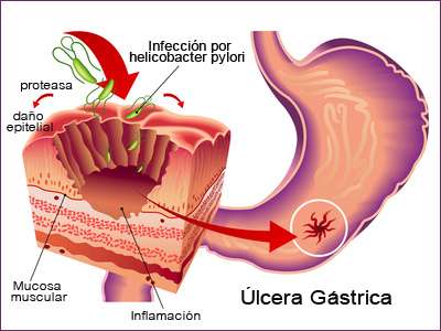 Ulcera por helicobacter pylori
